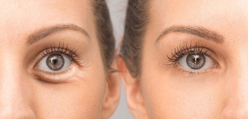 Oculoplastic Surgery - Boston Eye Physicians and Surgeons