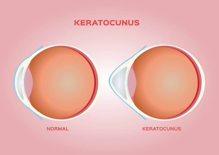 Keratoconus Care in Boston