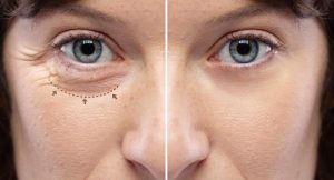 Blepharoplasty Boston, MA